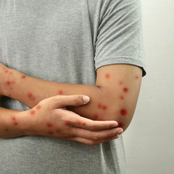 Imagen de recurso de una pesrona con sarampión. JUNTA DE ANDALUCÍA Imagen de recurso de una pesrona con sarampión. JUNTA DE ANDALUCÍA