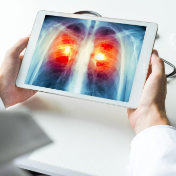 Cáncer de pulmón. ICAPEM