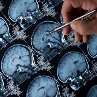 Imagen de recurso del estudio de un cerebro. ANGELINI PHARMA