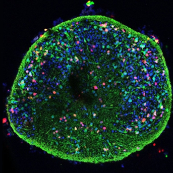Alteraciones celulares del Alzheimer, observadas también en cultivos de neuronas infectadas por virus del herpes labial CSIC