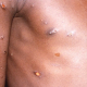 La OMS alerta del riesgo de transmisión comunitaria de mpox a menos que se contengan rápidamente los brotes existentes CDC