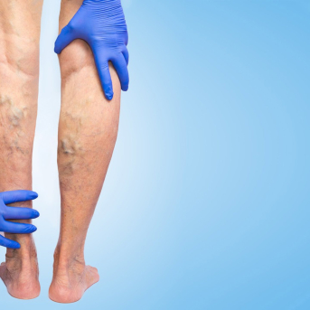 Imagen de recurso de una persona con trombosis venosa profunda. QUIRÓNSALUD