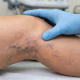 Imagen de recurso de unas varices. SERVEI