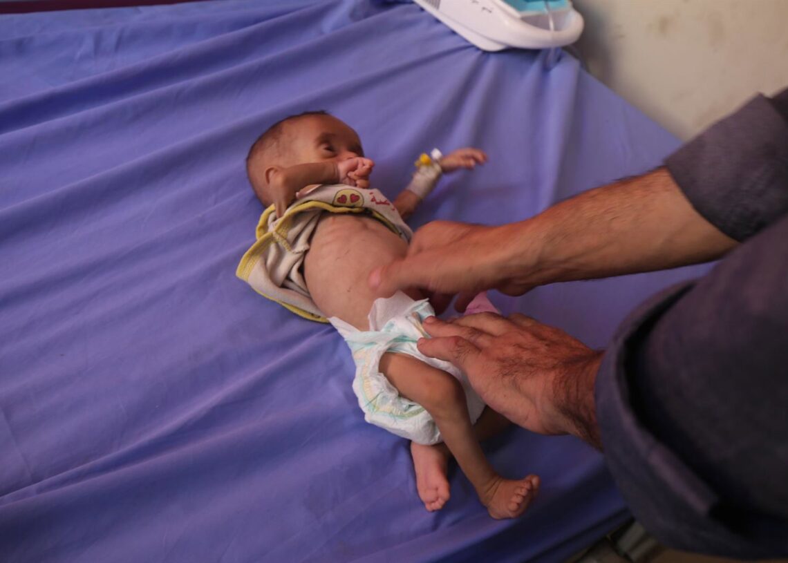 Un bebé con desnutrición es atendido en un hospital de la ciudad de Gaza, en medio de la ofensiva del Ejército de Israel contra la Franja de Gaza (archivo)Europa Press/Contacto/Omar Ashtawy
