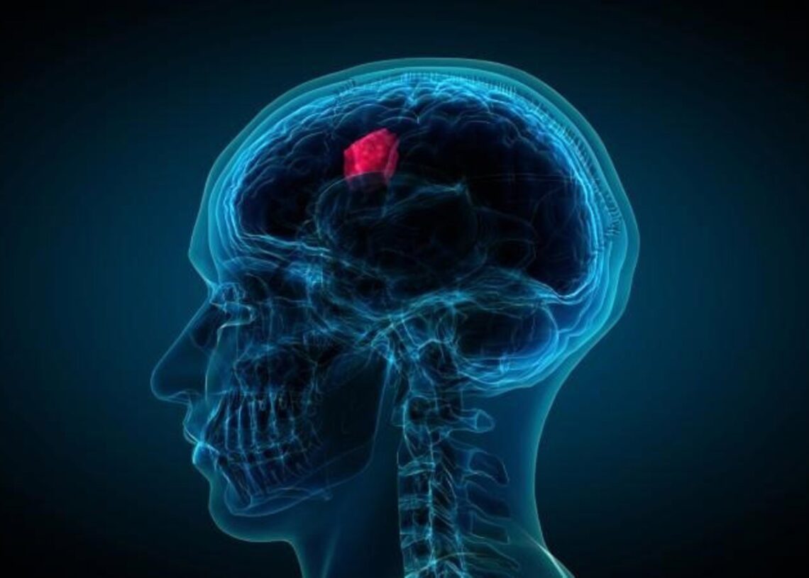 Archivo - Imagen de recurso de un glioblastoma.PENN MEDICINE - Archivo