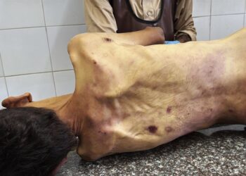 Cadáver en el Hospital Mártires de Al Aqsa de un palestino muerto por hambre y desnutrición por la ofensiva de Israel contra la Franja de Gaza y sus restricciones a la entrega de ayuda humanitaria (archivo)Europa Press/Contacto/Ahmed Ibrahim