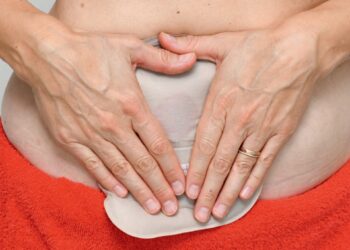 Archivo - Ostomía.HOLLISTER - Archivo