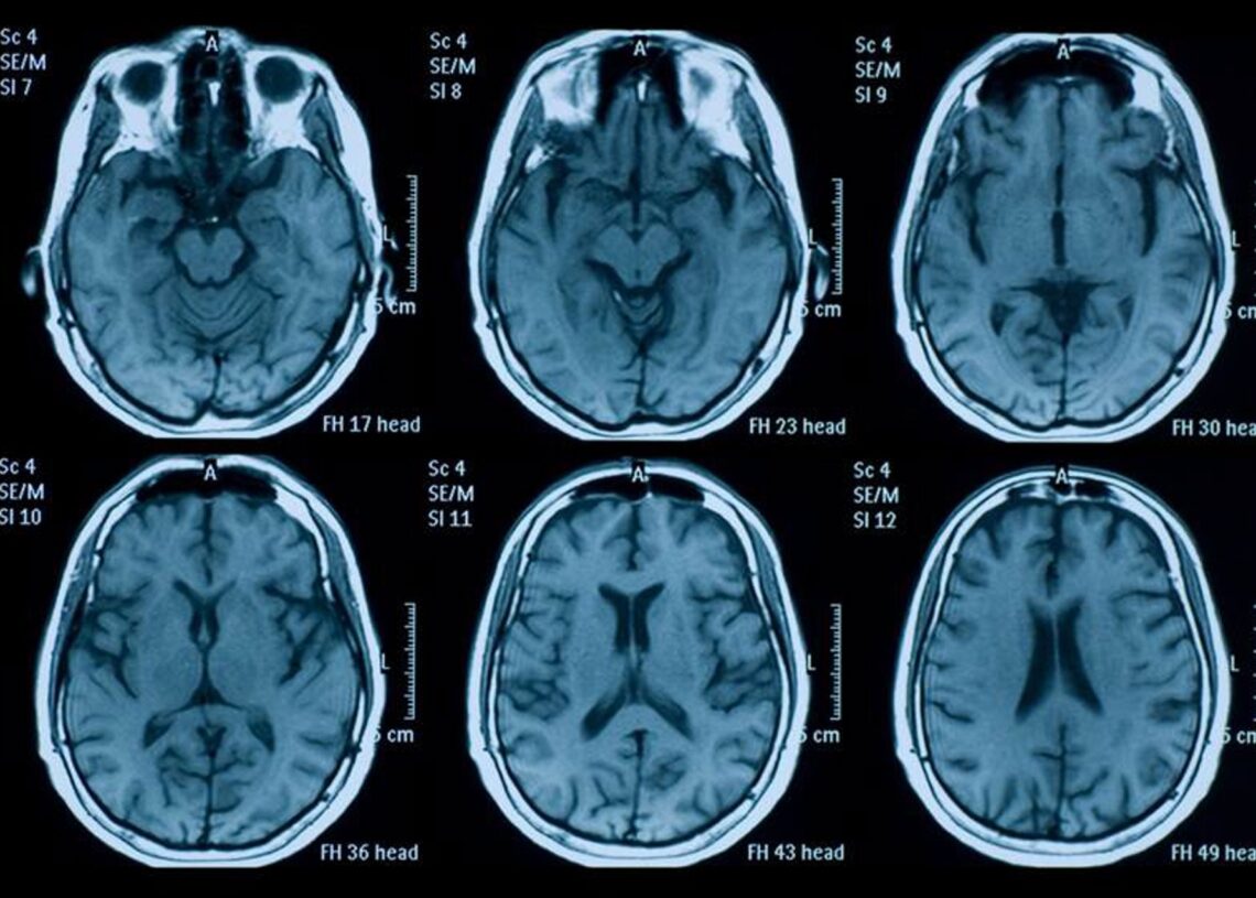 Identifican un compuesto con un efecto neuroprotector "significativo" en traumatismo craneoencefálico.CSIC