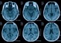 Identifican un compuesto con un efecto neuroprotector "significativo" en traumatismo craneoencefálico.CSIC