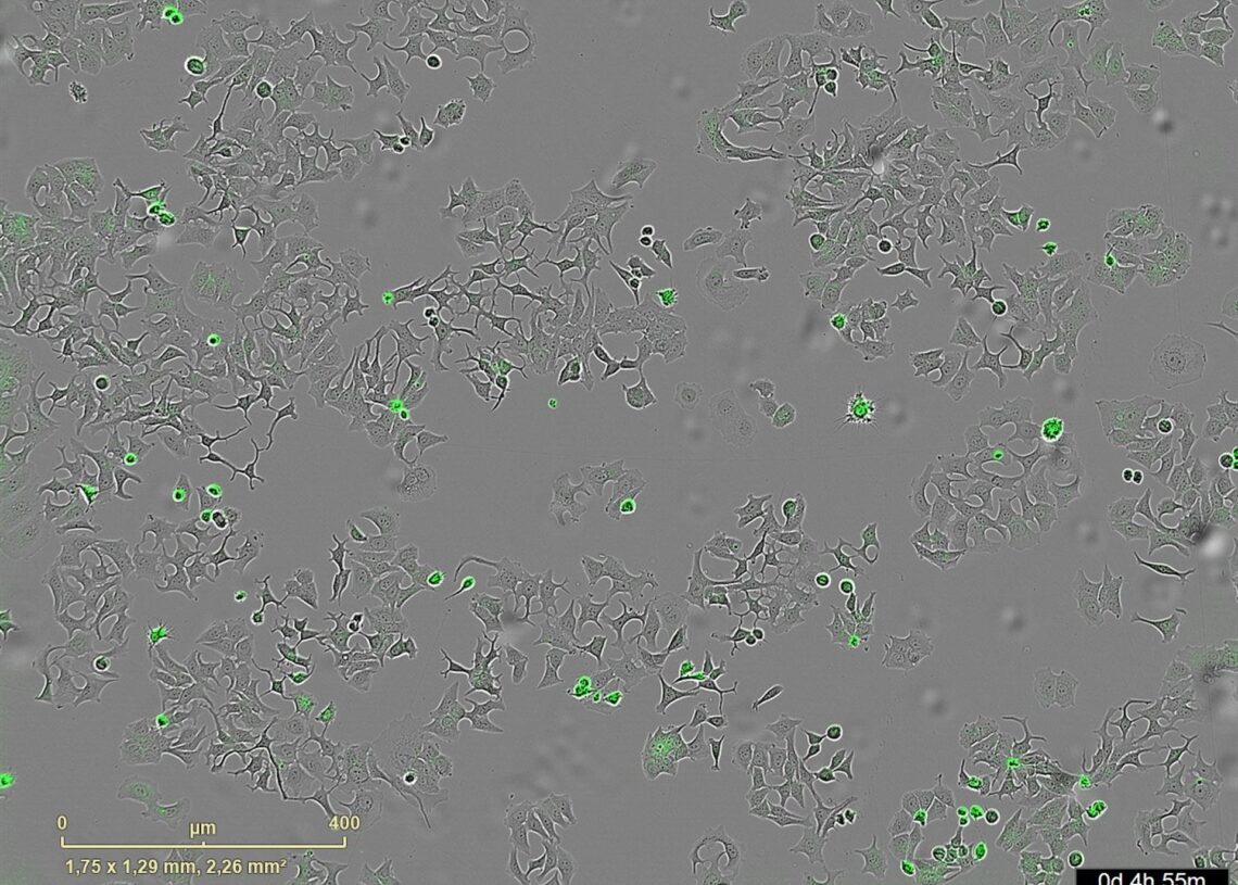 La imagen representa las células de cáncer muertas al activarse su proteína de membrana PAR-1 por la proteasa bacteriana HapA.CIC