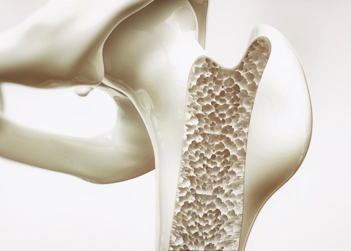 Archivo - Imagen de recurso de un hueso con osteoporosisUCB - Archivo