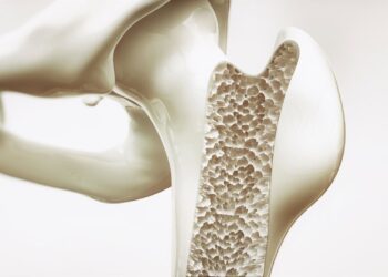 Archivo - Imagen de recurso de un hueso con osteoporosisUCB - Archivo