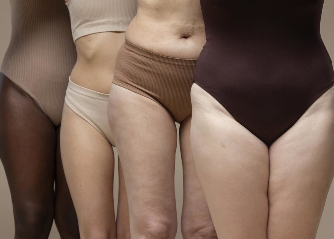 Archivo - Mujeres con lipedema.AECEP - Archivo