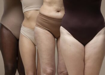 Archivo - Mujeres con lipedema.AECEP - Archivo