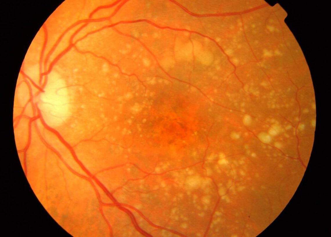 Archivo - Imagen de recurso de una retina con DMAE.IMO - Archivo