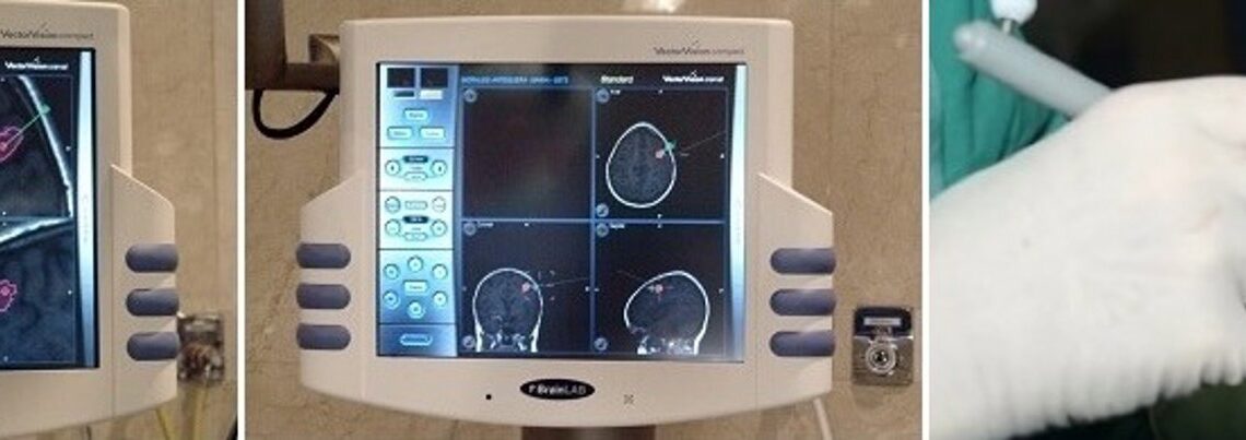 La neuronavegación permite tratar "con mayor precisión" los tumores cerebrales y la estenosis lumbarQUIRÓNSALUD