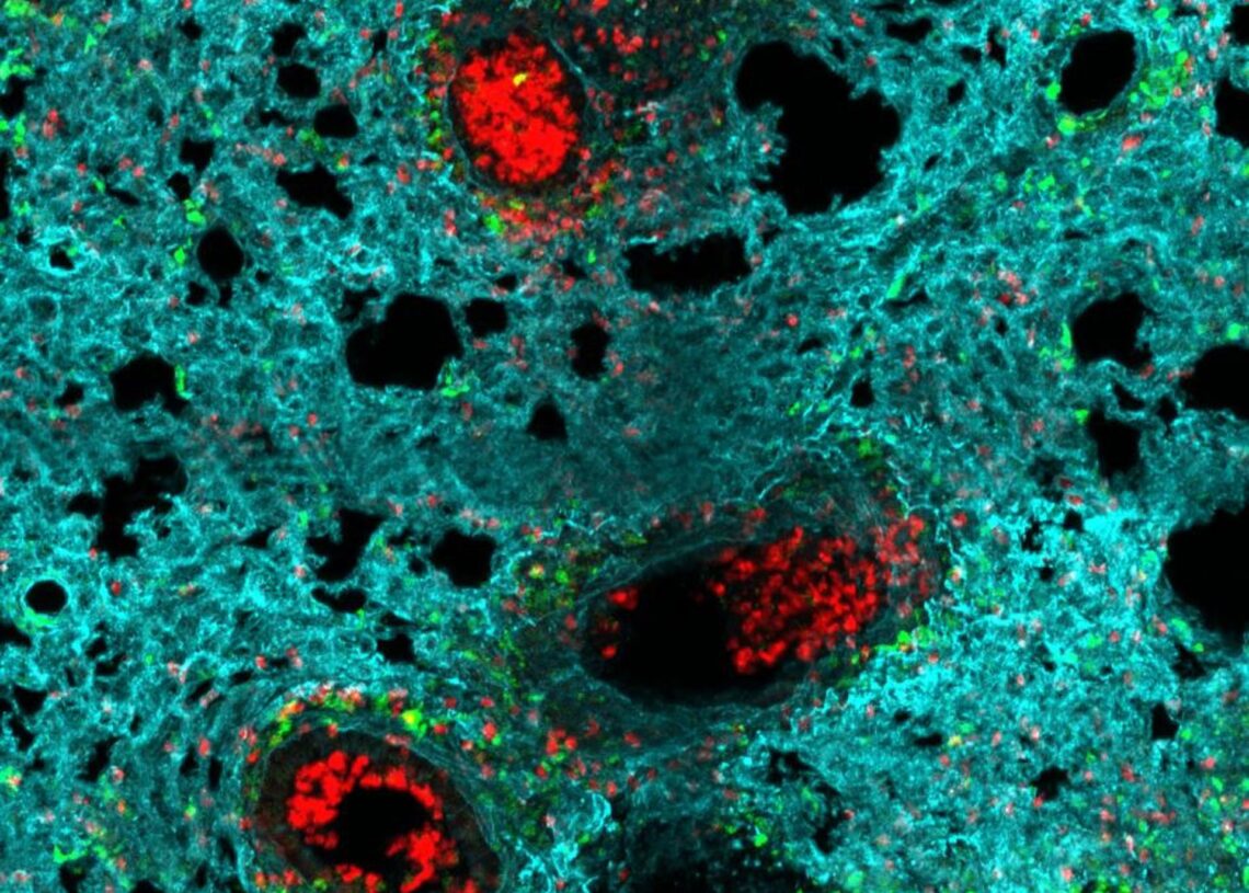 Neutrófilos (rojo) se acumulan en los alveolos de un pulmón infectado con gripe.IVÁN BALLESTEROS/CNIC